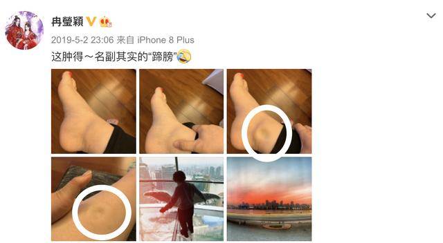 脚踝|乔欣象山拍戏被毒蚊子攻击，脚踝肿胀离谱，一按一个坑太夸张