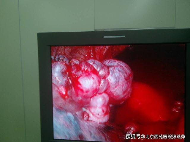 什么是肺大疱?