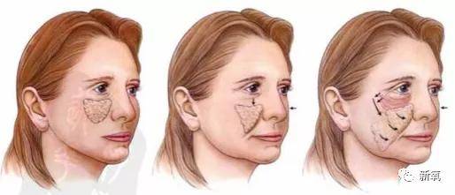 张脸|当年艳绝四方让张雨绮都甘心做配,可现在这张脸说崩就崩了...