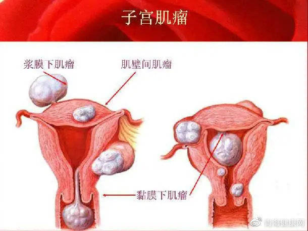 腹式子宫切除术,不必做腹部切口,仅通过人体自然通道——阴道完成手术