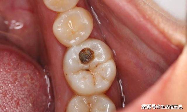 原创牙齿上使劲儿也抠不掉的黑点是什么?现在就告诉你实情