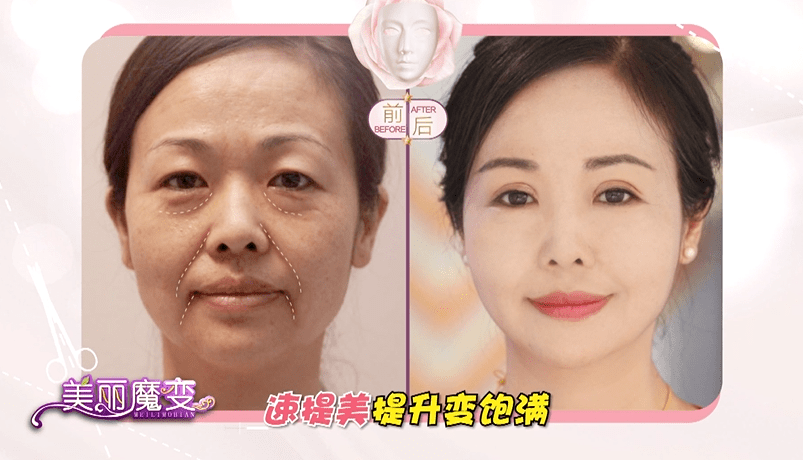 樊女士|四惠医美姚乃君主任速提美案例故事：女人打不垮，更要脸不垮