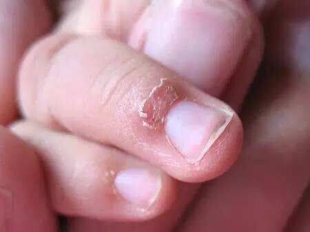 兽皮症:孩子手上长倒刺,是身体缺啥吗?原来通过手指多