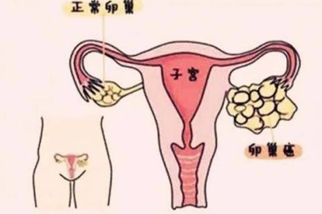 "卵巢有癌,腹部先知"?身体出现3种异常,可能是癌症在靠近