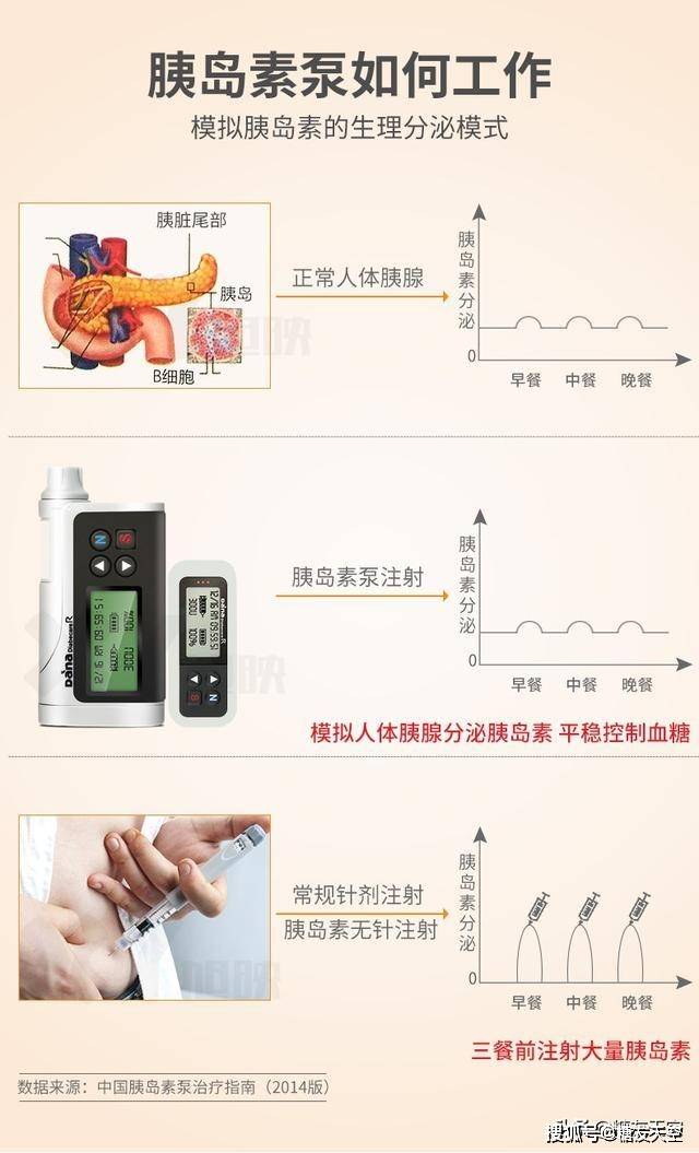 胰岛素笔,无针注射器,胰岛素泵哪个好?