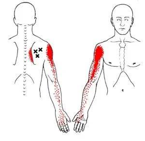 导致肩胛骨内侧缘疼痛的所有肌肉,对照自己能否正确找出病因_症状