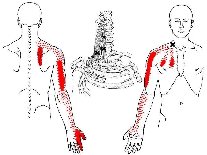 导致肩胛骨内侧缘疼痛的所有肌肉,对照自己能否正确找出病因