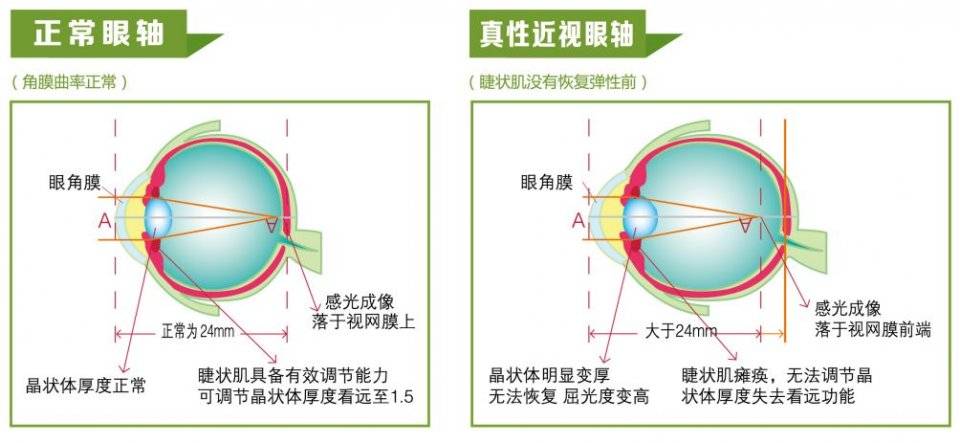 中国近视人口_护眼系列 四 孩子视力差,父母是罪魁