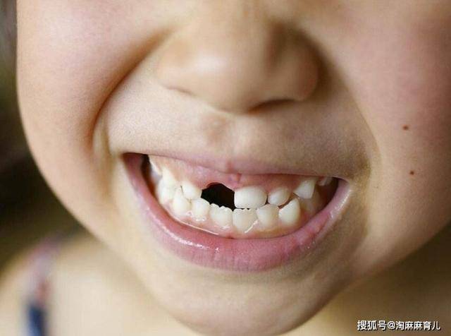 恒牙|网友说，太丑太吓人整牙医生说：这才是我们最想看到的乳牙