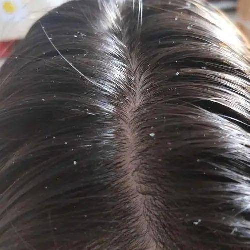 人间|叹头部SPA!拒做人间“油”物,解锁防秃养发小妙招!