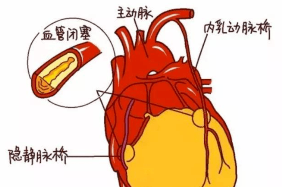 心脏|百年协和讲堂 | 如何区分心绞痛和心梗？专家教你“找不同”