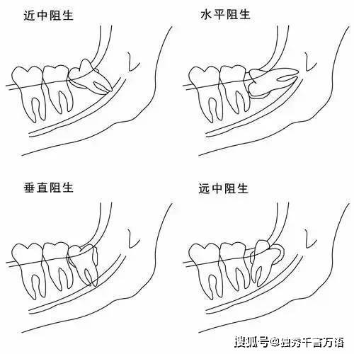 智齿可带来六大隐患,如何智慧对待"智慧牙?