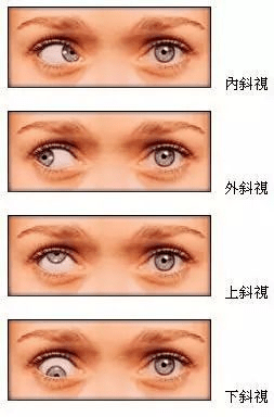 宝宝|有可能是这种病！家长越早发现越好！宝宝看东西喜欢歪头、眯眼并非可爱
