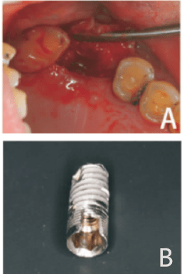 钛种植体折裂的临床处理及相关因素讨论_zimmer