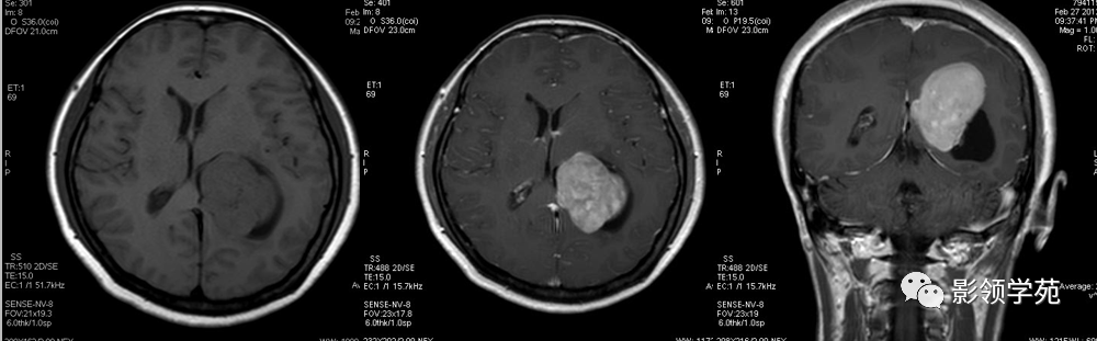侧脑室肿瘤的影像诊断与鉴别