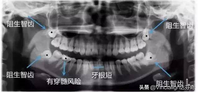 2.,牙根周围可能有影响牙齿移动的因素