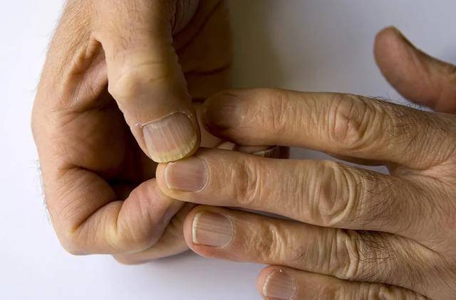 纤纤十指,隐藏健康信息.为何手上有倒刺,指甲有竖纹?