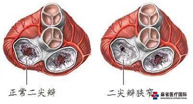 什么原因导致心脏二尖瓣关闭不全 7fa181a7e69d4ebba0c498b1d241b28f.jpeg