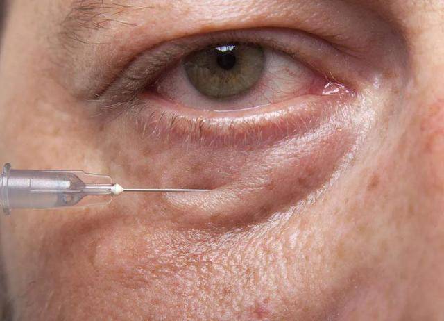 女明星|女明星“眼下增肥”是什么操作？