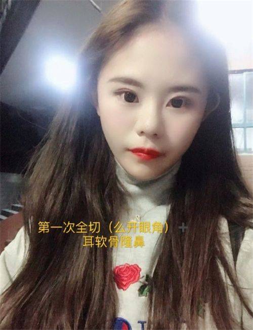 母亲|女孩为了变美，花100万疯狂整容，扬言母亲支持，前后对比如换脸