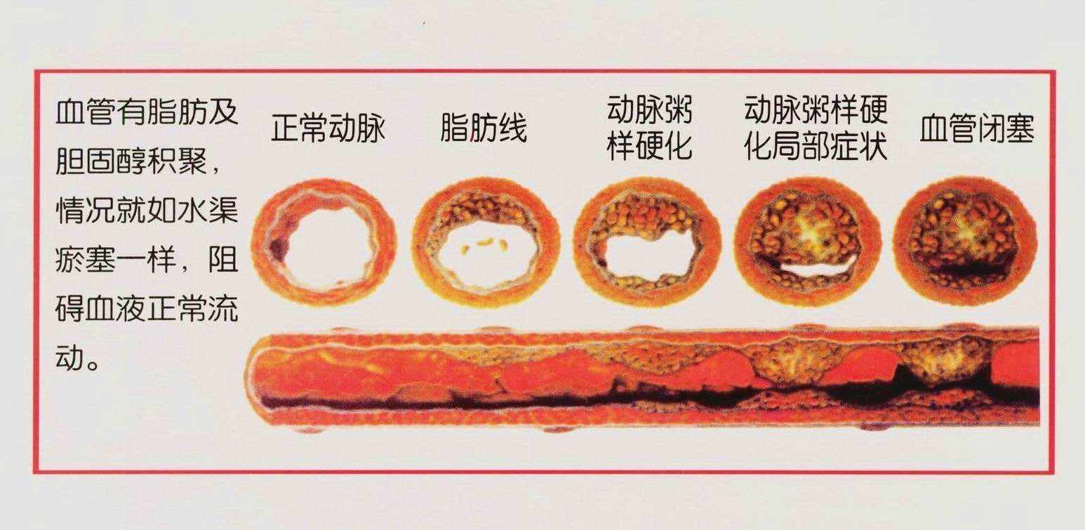 好好的血管怎么就"硬"了?教你一招远离动脉粥样硬化