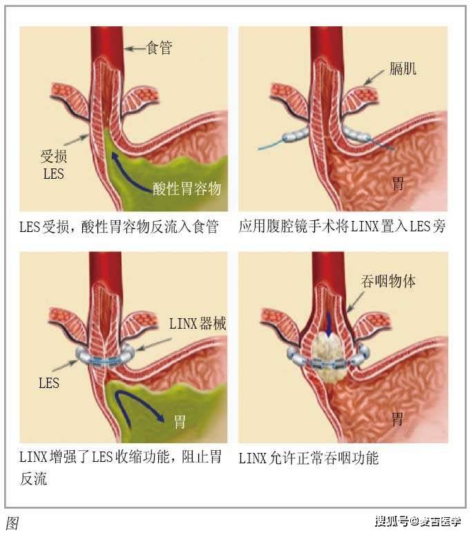 barrett食管是什么疾病?知道这4点,你就了解它了