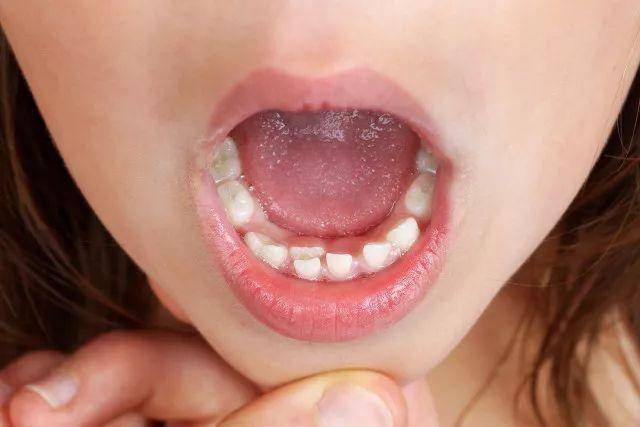 为何现在“双排牙”的孩子越来越多？医生：跟家长脱不了干系！
