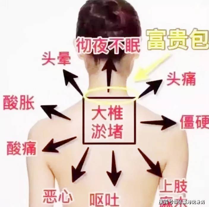 咋样快速消除富贵包 50e2e031cb3e4aff8cd354583719aac2.jpeg