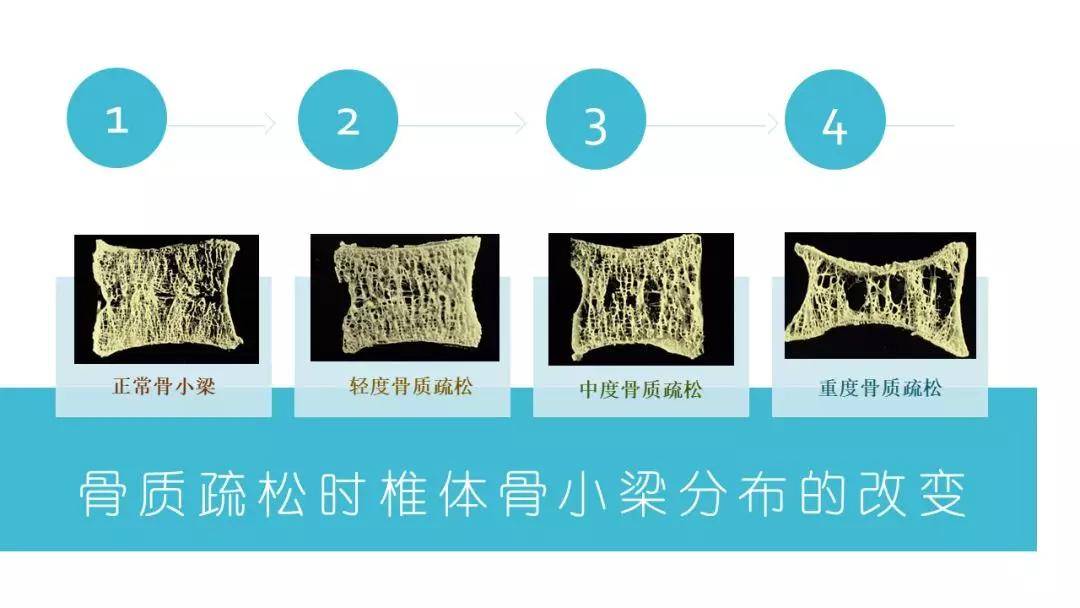 与正常骨相比,骨质疏松症患者的骨密度,强度都显著降低,所以更容易