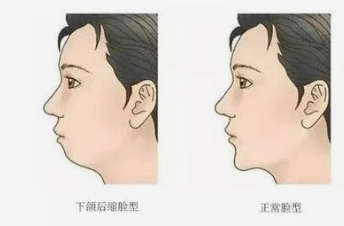 "下颌后缩"指的是下巴短小,后缩,如下图.