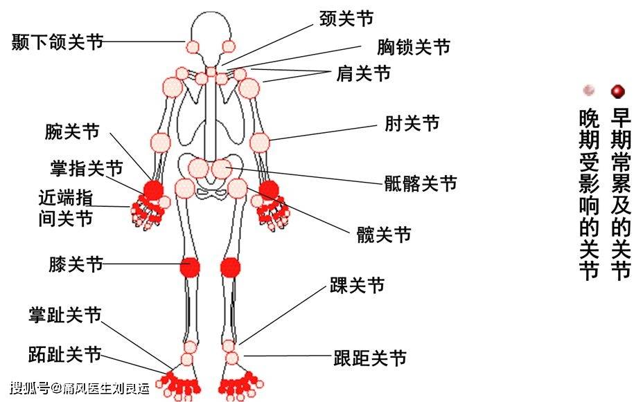 建议收藏:类风湿性关节炎患者诊疗大全手册