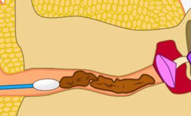 用棉签掏耳朵,看似卫生或许最伤身,正确掏耳屎的方法了解一下