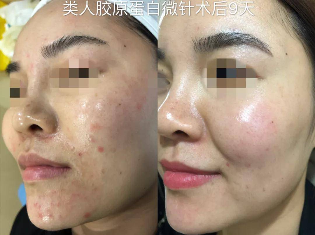 镜子|以前拿央视镜头当镜子，现在十级滤镜都磨不平，刘亦菲鼻子到底咋了？