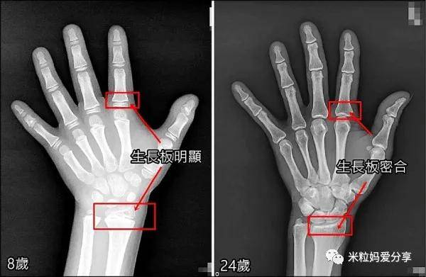 女孩|这件事一定不能忽略3岁女孩被喂到70斤！除了肥胖