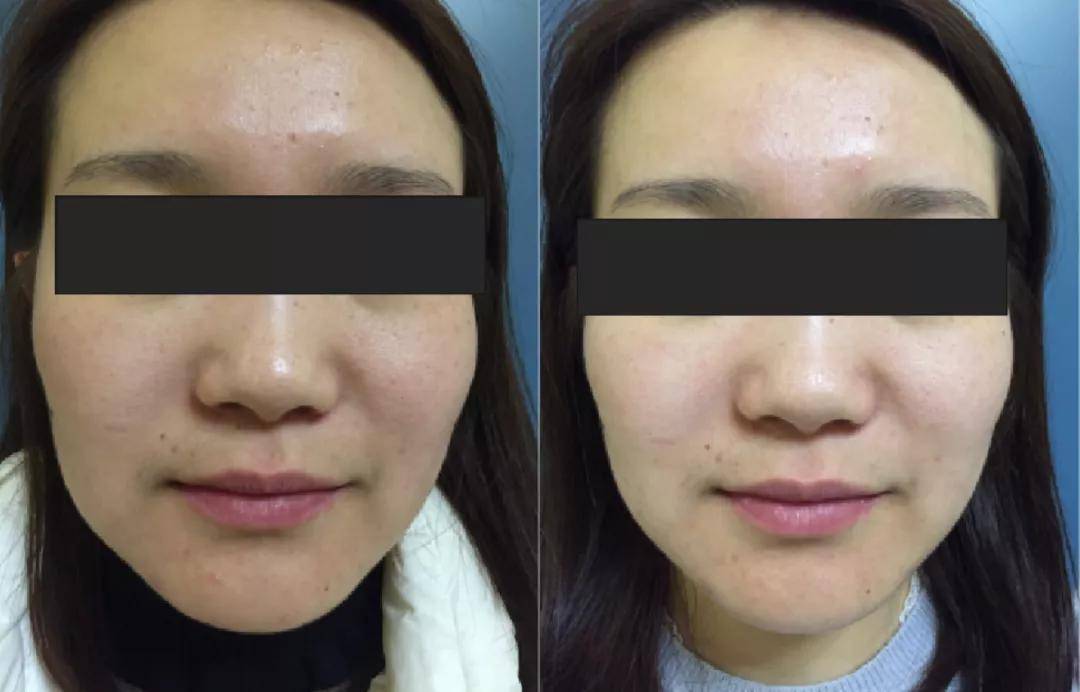 镜子|以前拿央视镜头当镜子，现在十级滤镜都磨不平，刘亦菲鼻子到底咋了？