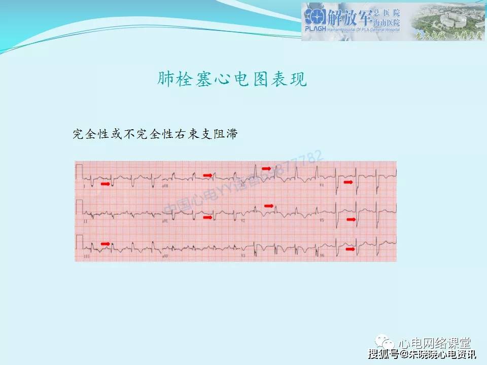 肺栓塞心电图表现及鉴别诊断