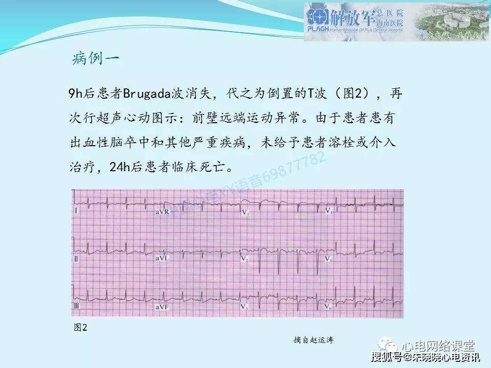 肺栓塞心电图表现及鉴别诊断