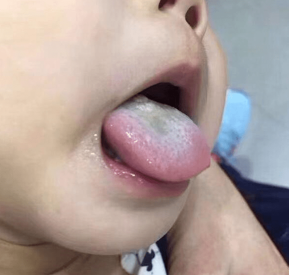 晚一点|眼袋长成这样，医师：再晚一点，孩子就停止发育了！3岁男孩