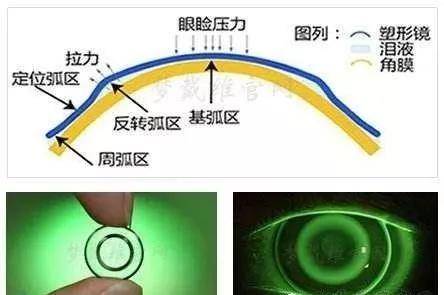 蛋白矫正沙发原理是什么_蛋白线是什么样子图片