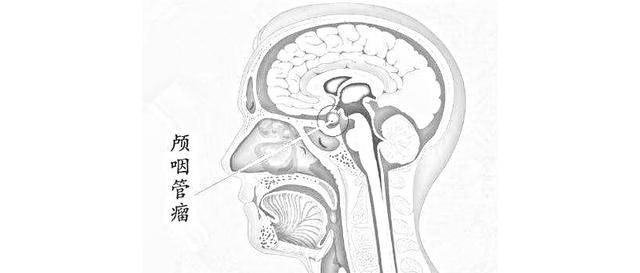 医生是怎么判断是不是全切了颅咽管瘤的?