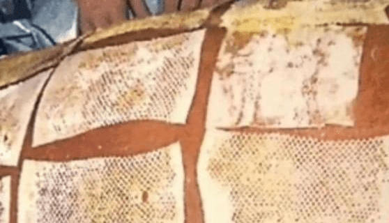 他皮肤脱落贴胶布,23对染色体完全紊乱,医生全力救治83天被埋怨