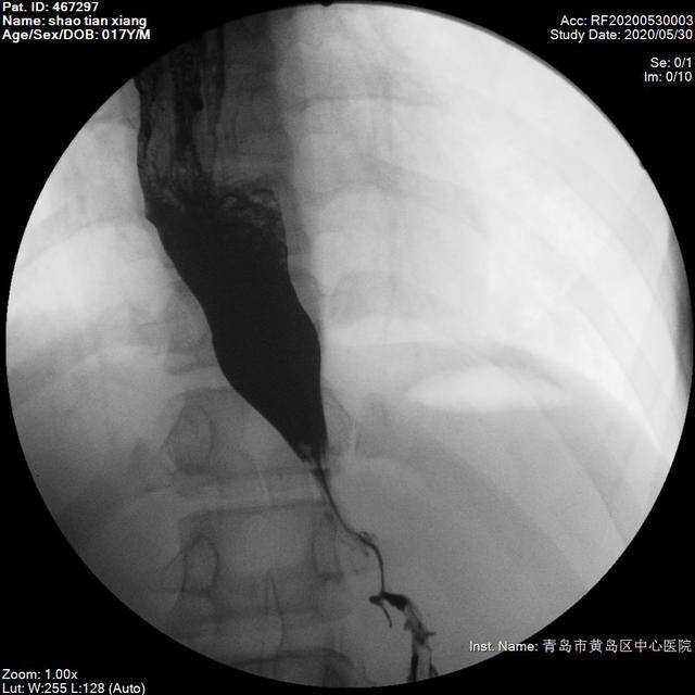 下图是患者食管钡餐的图片 食管下段与贲门交界处管腔变窄 呈鸟嘴状