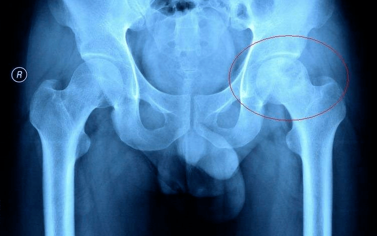 科学防治:正确认识"股骨头坏死"!