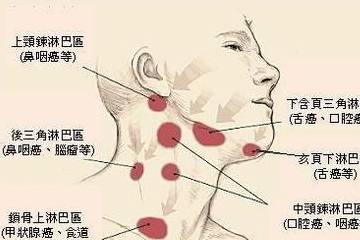 淋巴瘤GDP方案是什么_什么是淋巴瘤图片