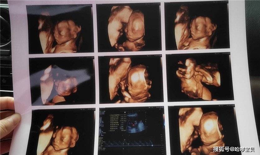 四维彩超几个月做一次 0aaeb01559da46b09b469fa9be0609f8.jpeg