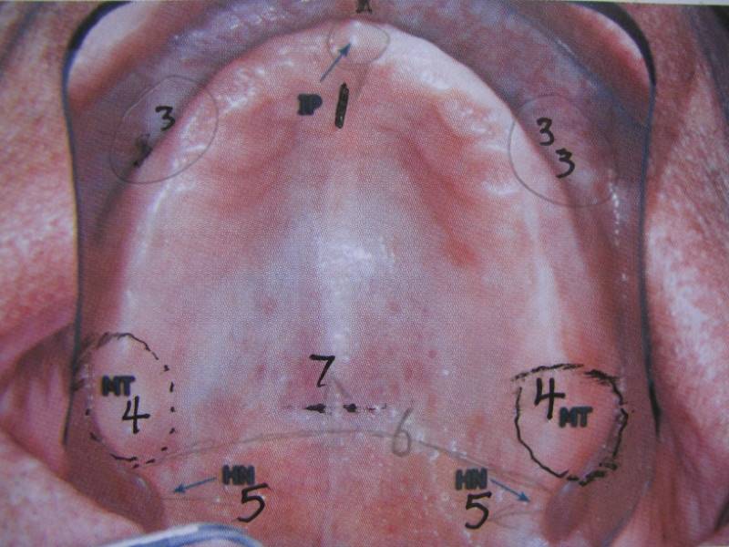 1切牙乳突 2 唇系带 3颊系带 4上颌结节 5翼突切迹 6颤动线 7腭小凹