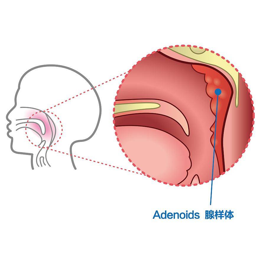 孩子十岁之后腺样体就会萎缩,我们把这种现象称之为腺样体生理性的