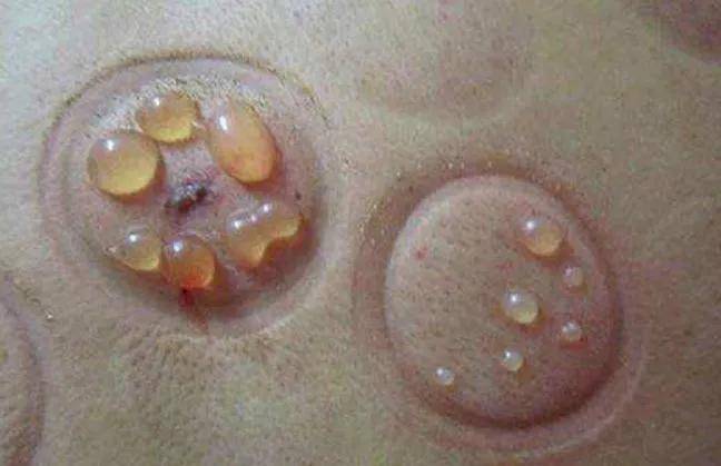 拔罐为啥不发紫 439e80087cec46888f7caa511d346660.jpeg