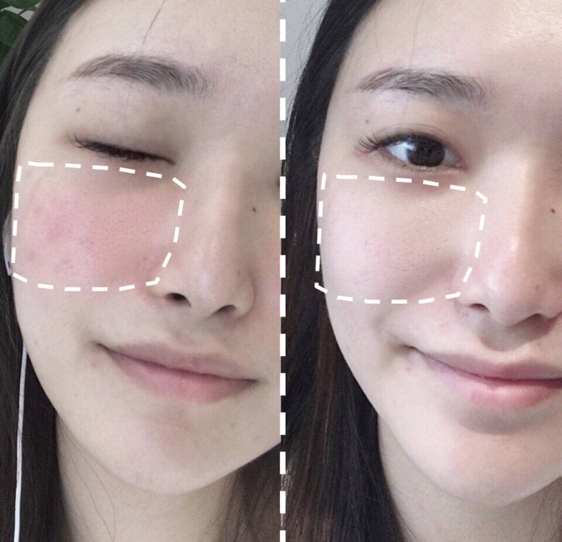 皮肤|口罩脸+换季!这下真的受不了了,敏感修复快看它