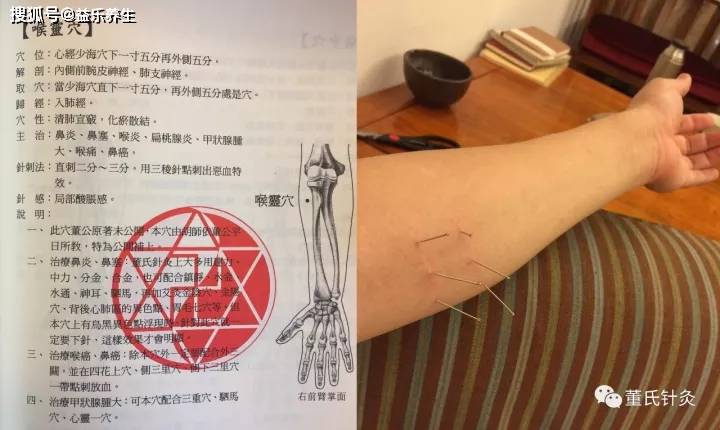 董氏奇穴针灸慢性咽炎处方